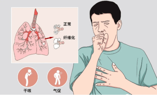 什么是间质肺炎？肺纤维化？