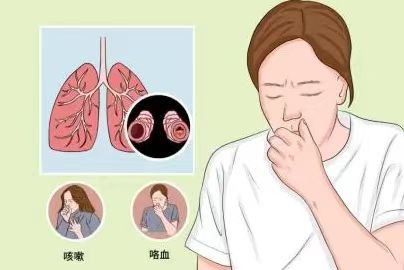 得了支气管扩张，有什么影响？